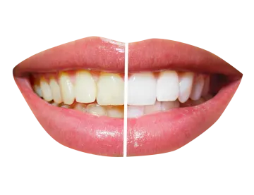 a woman's teeth before and after whitening