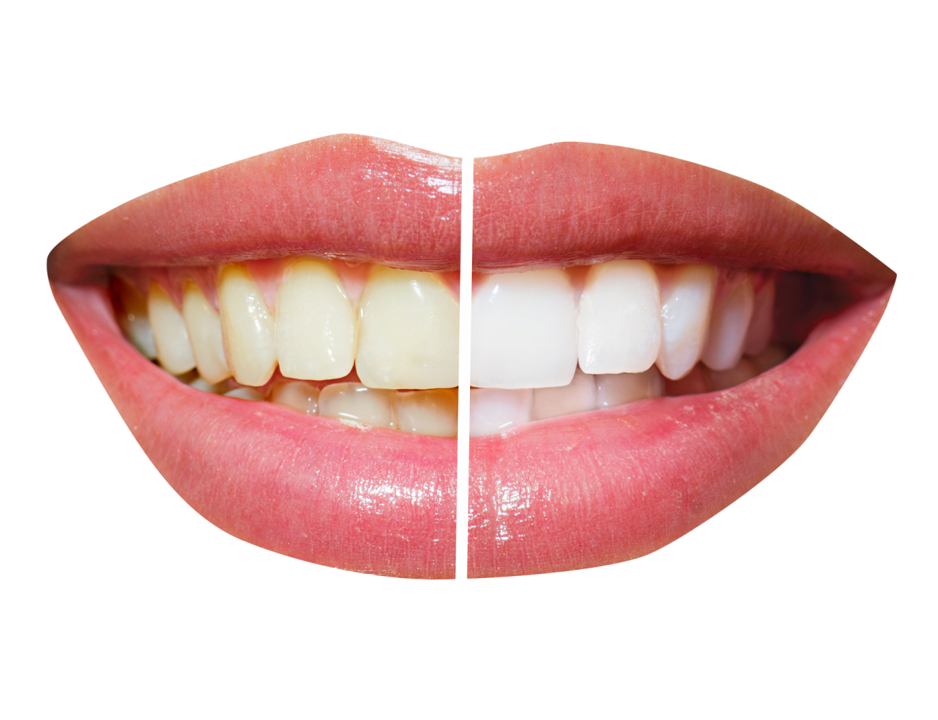 a woman's teeth before and after whitening